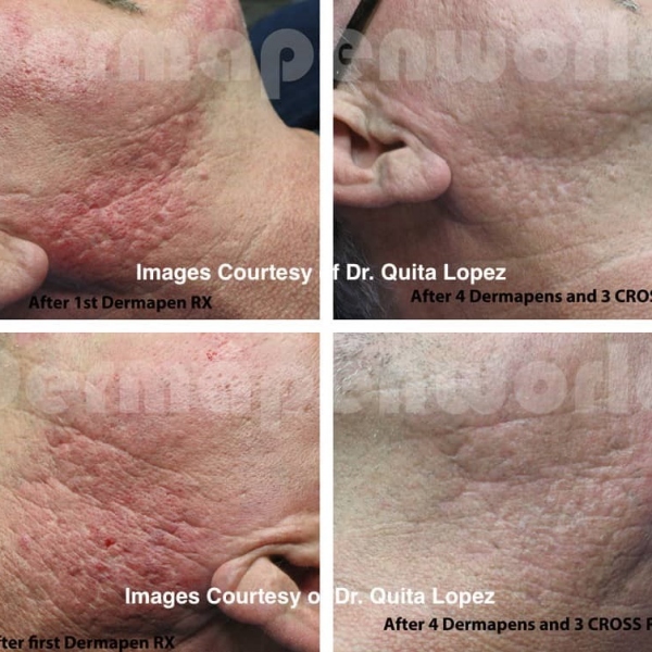 Dermapen before & after pictures